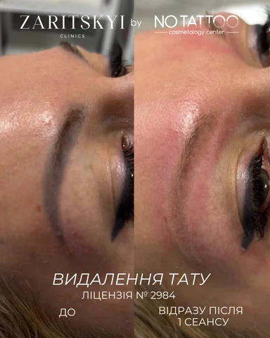 Лазерне видалення татуажу та перманентного макіяжу - NO TATTOO