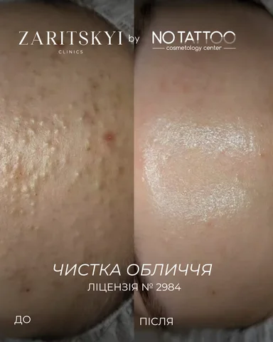 Чистки - NO TATTOO