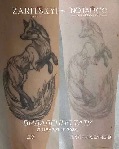 Лазерне видалення татуювань - NO TATTOO