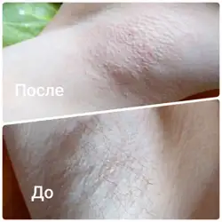 Олександра Мухортова майстер депіляції