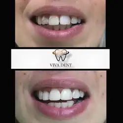 Viva dent