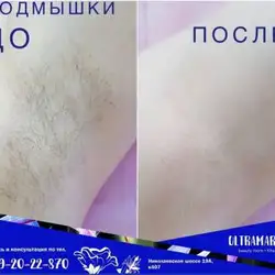 Альона Дронь майстер депіляції