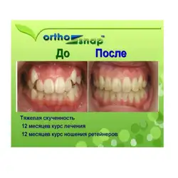 Елайнер Aligners