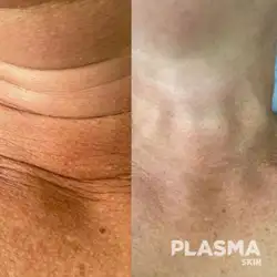 Plasma Skin Cosmetology