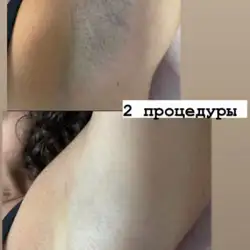 Слободенюк Яна майстер епіляції